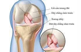 Đứt dây chằng chéo có ảnh hưởng đến phát triển chiều cao không?