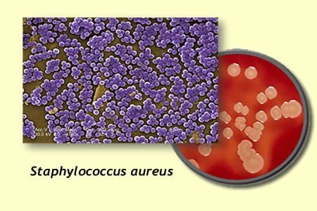 
Staphylococcus aureus là một trong các vi khuẩn gây viêm tuyến nước bọt mang tai ở trẻ em
