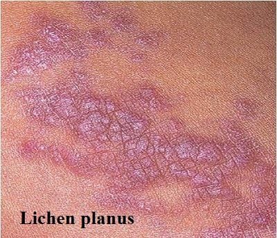 Trẻ bị Lichen điều trị thế nào?