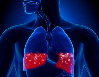 Pulmonary edema, also known as congestive lung disease, is a condition caused by an excess of fluid in the lungs.