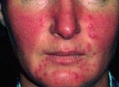 
Nếu bạn uống rượu bị đỏ mặt có thể là do mắc bệnh rosacea
