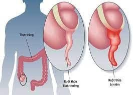 Signs of appendicitis in the elderly