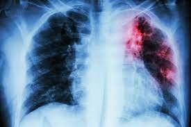 Xơ phổi 1/3 phổi giữa có nguy hiểm không?