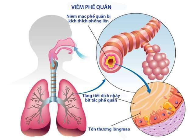 7. Từ Vựng Tiếng Trung Liên Quan Đến Viêm Phế Quản