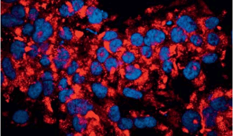 Impaired beta cell function and type 2 diabetes