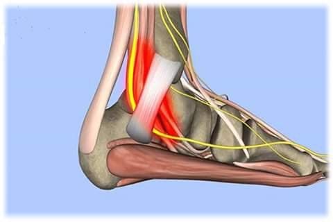 Phục hồi chức năng hội chứng đường hầm cổ chân