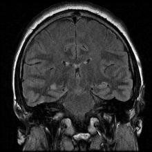 
Hình 1. Xơ hoá hồi hải mã bên phải trên chuỗi xung FLAIR của phim MRI
