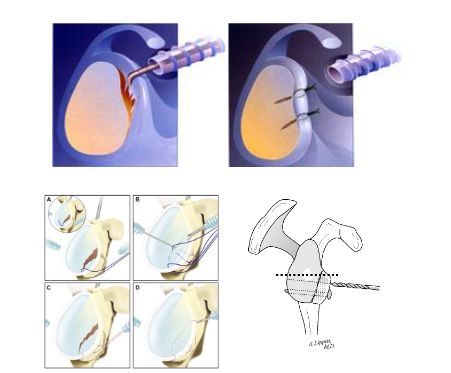 
Minh hoạ một số kỹ thuật mổ với các dạng tổn thương khác nhau của trật khớp vai tái diễn: Phẫu thuật khâu phục hồi trong tổn thương sụn viền bao khớp đơn thuần, kỹ thuật khâu phục hồi Bankart xương , kỹ thuật mổ mở ghép xương mào chậu
