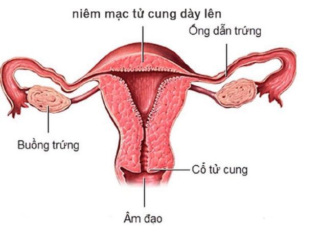 Phương Pháp Đánh Giá và Chẩn Đoán Độ Dày Nội Mạc Tử Cung