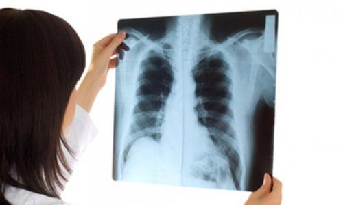 Kết quả X quang phổi có các nhánh phế quản hai bên đậm nghĩa là gì?