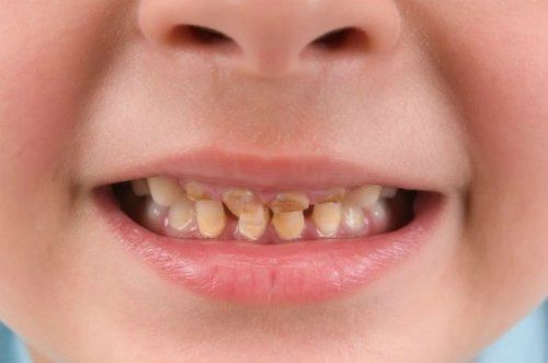 What to do when the baby has worn out baby teeth?