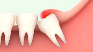 Răng khôn mọc lệch có ảnh hưởng đến khớp thái dương hàm không?