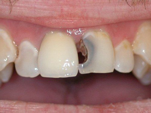 Does interdental caries need treatment?