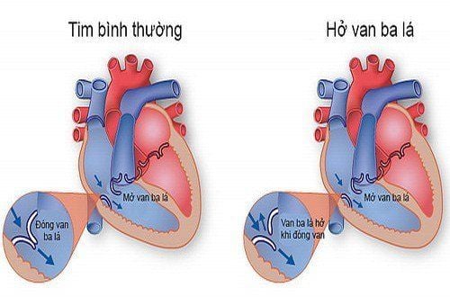 Hở van tim 3 lá 1/4 có nguy hiểm không?