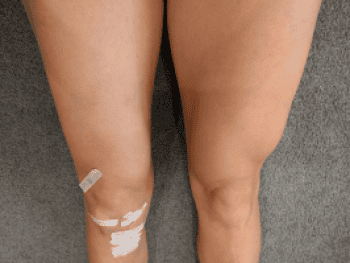 Chân to chân nhỏ sau gãy xương đùi 1 tháng có sao không?