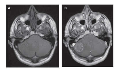 
Hình 1. Phim MRI chuỗi xung T1 không tiêm đối quang (A) và có tiêm đối quang (B) cho thấy tổn thương tăng đối quang không đồng nhất ở tiểu não phải, tương thích với hình ảnh u di căn.
