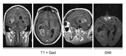 
Hình 1. Phim MRI cho thấy khối u nguyên bào thần kinh đệm ở thái dương phải. Chuỗi xung T1 sau tiêm đối quang mặt phẳng coronal, axial, và sagittal (từ trái sang phải) cho thấy tổn thương bắt đối quang không đồng đều và có hiệu ứng choán chổ kèm phù nề, tương thích với hình ảnh của u nguyên bào thần kinh đệm. Hình ảnh ngoài cùng bên phải là ở chuỗi xung khuếch tán (DWI) cho thấy không có sự giới hạn khuếch tán, điều này giúp loại trừ ap-xe não.
