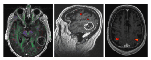 
Hình 2. MRI chức năng xác định các dãi chất trắng (hình trái), vùng ngôn ngữ (hình giữa) và vùng vận động của tay (hình phải).
