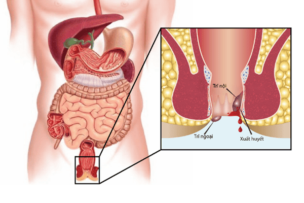 7. Lưu Ý Khi Điều Trị và Sống Chung Với Bệnh Trĩ