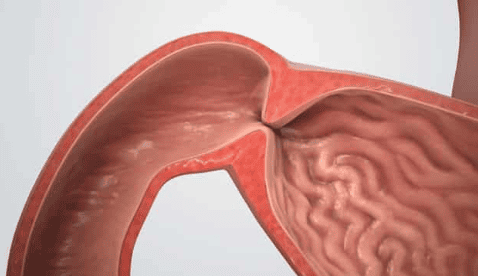 Complications of pyloric stenosis