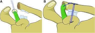 
Hình 2: Ảnh minh họa kĩ thuật Weaver Dunn cải tiến với Tighrope.
