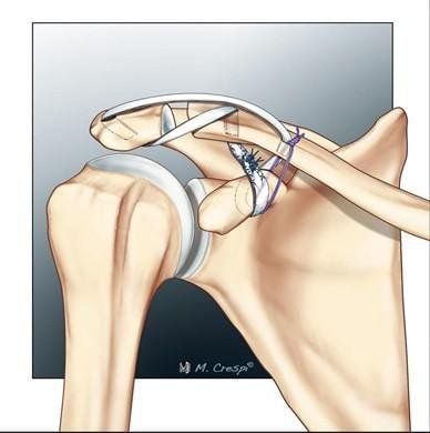 
Hình 3: Ảnh minh họa kĩ thuật tái tạo dây chằng cùng vai đòn, quạ đòn theo giải phẫu
