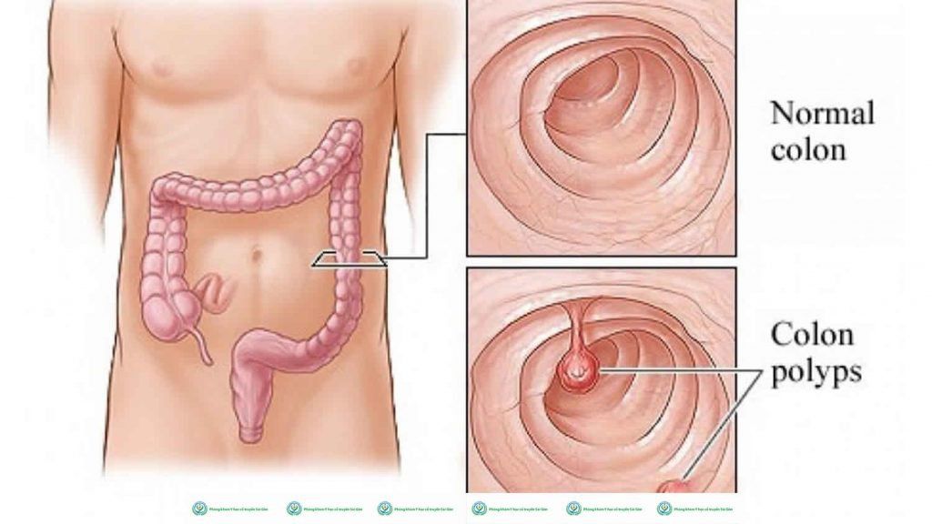 Bệnh Adenoma: Tìm Hiểu Nguyên Nhân, Triệu Chứng và Phương Pháp Điều Trị Hiệu Quả