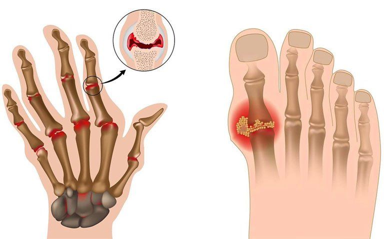 Bị Gout Có Hết Không? Tìm Hiểu Cách Điều Trị Hiệu Quả Ngay Hôm Nay