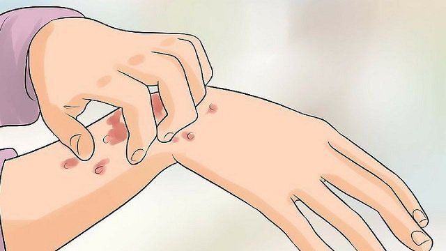 Triệu Chứng Nhiễm HIV Sau 3 Tháng: Nhận Biết Sớm Và Phương Pháp Phòng Ngừa