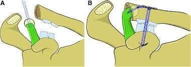 
Figure 2: An illustration of the advanced Weaver Dunn technique using TightRope.
