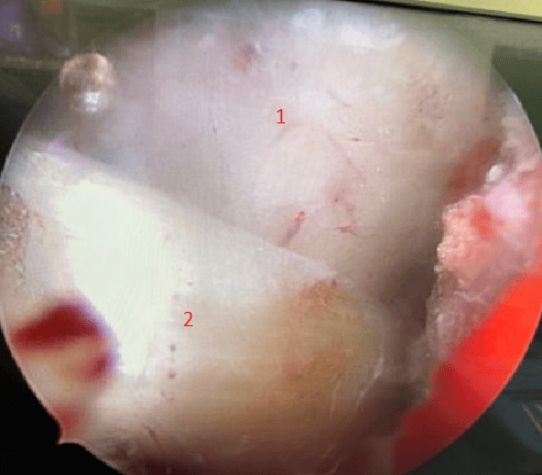 
Image 5: The arthroscopic image of the shoulder joint shows the coracoid (number 1 in red on the left). We drill 2 tunnels above the clavicle at the anatomical position of the conoid ligament and trapezoid ligament (number 3 in blue on the right). Next, we insert the semi-tendons through 2 tunnels and the coracoid (number 2 in red) and fixate the 2 tendons with a dissolvable vis. Finally, we stitch the remaining tendon to the acromion to restructure the acromioclavicular ligament.
