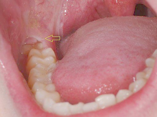 4. Biến Chứng Có Thể Xảy Ra