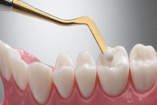 Trám răng có đau không và mất bao lâu?