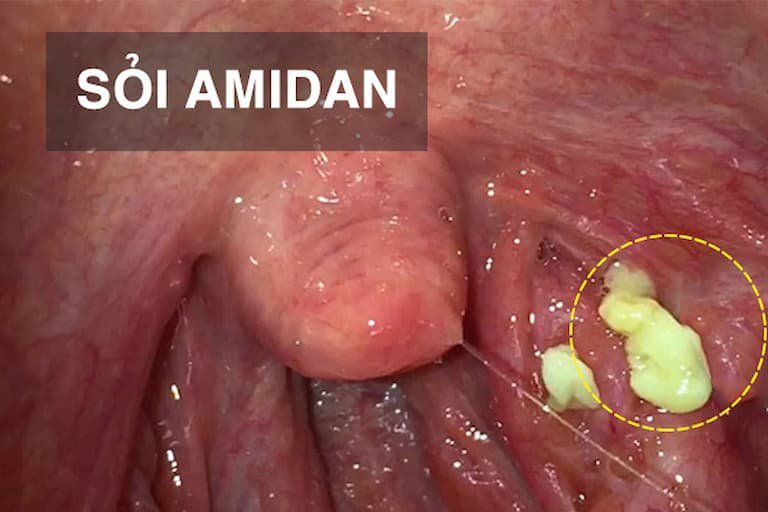 7. Tầm quan trọng của việc điều trị sớm