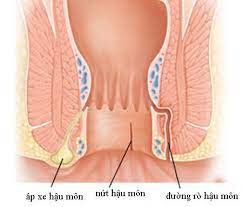 Bệnh rò hậu môn có triệu chứng gì?