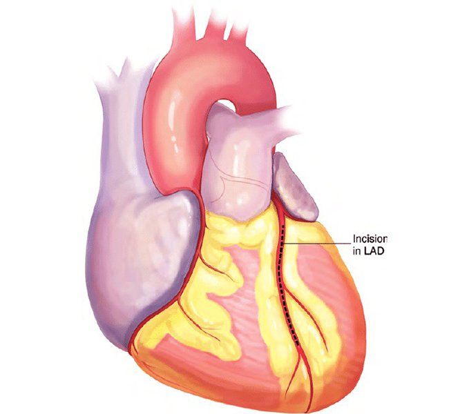 Hẹp LAD là gì? Tổng quan nguyên nhân, triệu chứng và phương pháp chẩn đoán, điều trị