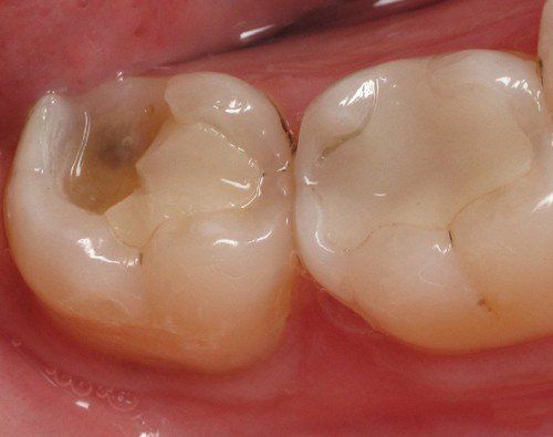 Răng bị vỡ có hồi phục được không?