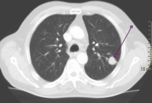 
Chụp CT- Scanner có thể phát hiện ung thư phổi
