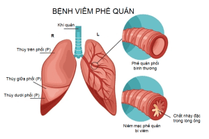 Theo dõi viêm phế quản tại nhà: Những điều cần biết