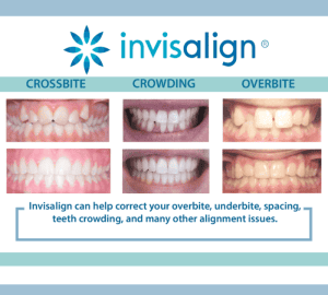 Invisalign và các khí cụ chỉnh nha khác - Sự khác biệt