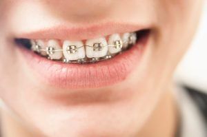 Invisalign và các khí cụ chỉnh nha khác - Sự khác biệt