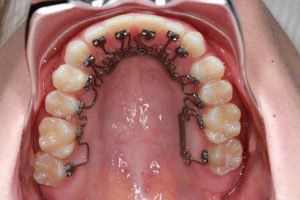 Invisalign và các khí cụ chỉnh nha khác - Sự khác biệt