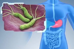 Vi khuẩn HP (Helicobacter Pylori) là một nguyên nhân gây viêm dạ dày rất phổ biến. 
