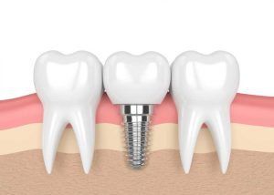 
Implant là phương pháp phục hồi lại chức năng những chiếc răng đã mất
