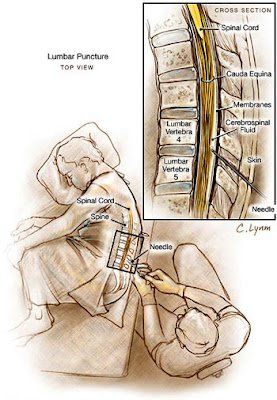 Viêm não tủy hậu nhiễm: chẩn đoán và điều trị