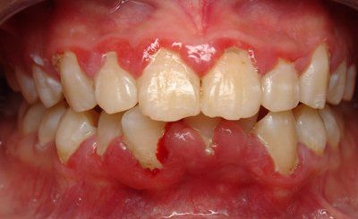 Điều trị bệnh quanh răng trong nha khoa