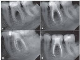 Các chỉ định khi chụp phim răng cận chóp