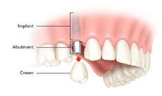 Trồng răng implant trong nha khoa là gì?