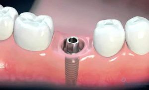 Implant nha khoa bị đào thải, nguyên nhân và cách khắc phục