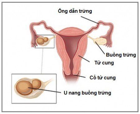 Các loại u nang buồng trứng thực thể thường gặp?